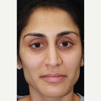 32 year old female treated with Botox before 3418019
