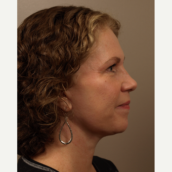 55-64 year old woman treated with Facelift after 3031650