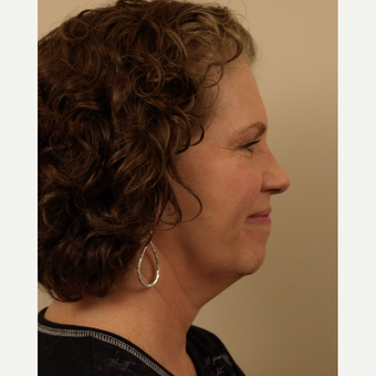 55-64 year old woman treated with Facelift before 3031650