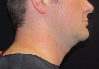 33 year old man treated with NeckTite RFAL before 3683584