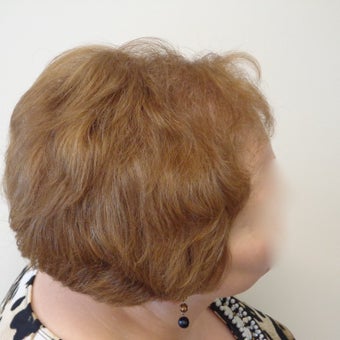 58-year-old woman after 1011grafts after 1955140