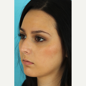 18-24 year old woman treated with Rhinoplasty before 3618491