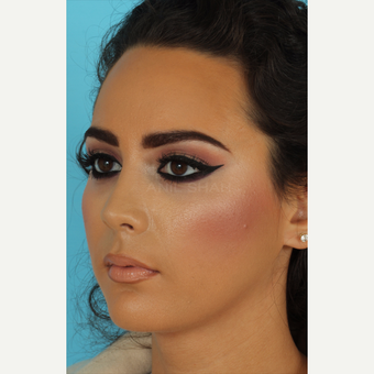 18-24 year old woman treated with Rhinoplasty after 3618491