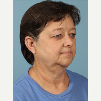 55-64 year old woman treated with Facelift before 3617711