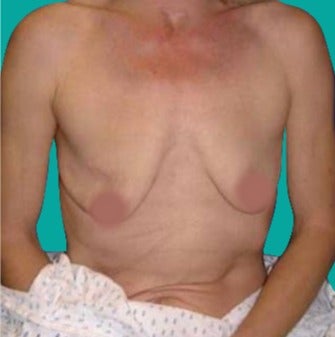 45-54 year old woman treated with Breast Augmentation before 3242208