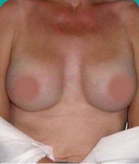 45-54 year old woman treated with Breast Augmentation after 3242208
