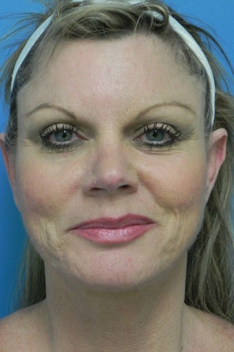 52 Year Old Female ~ Necklift after 1350455