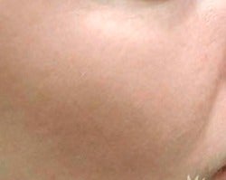 18-24 year old man treated with IPL after 3252227