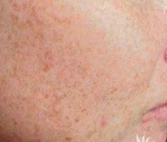 18-24 year old man treated with IPL before 3252227