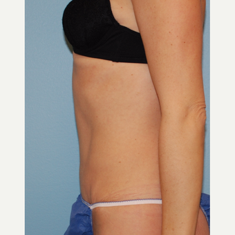 38 year old mother of 3 treated with Tummy Tuck including muscle repair after 3220188