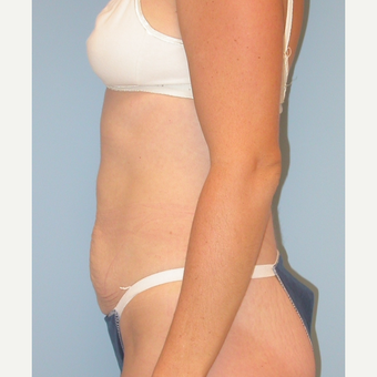 38 year old mother of 3 treated with Tummy Tuck including muscle repair before 3220188
