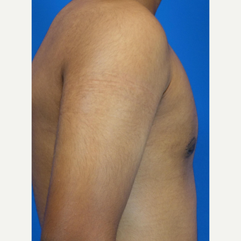 18-24 year old man treated with Male Breast Reduction after 3542888