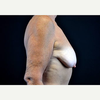 55-64 year old woman treated with Breast Implants before 3440915