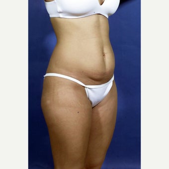 29 year old woman treated with Mini Tummy Tuck 1602946