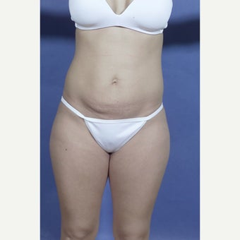 29 year old woman treated with Mini Tummy Tuck before 1602946