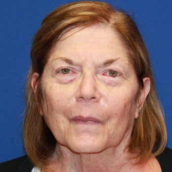 70 year old woman treated with CO2 Laser before 2659891
