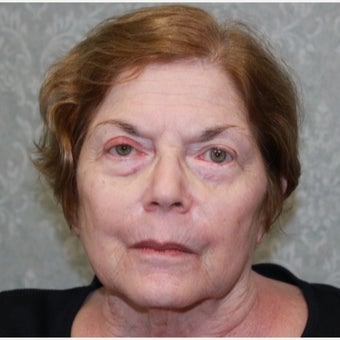 70 year old woman treated with CO2 Laser after 2659891