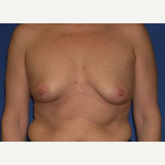 35-44 year old woman treated with Breast Augmentation before 3220033