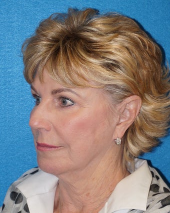 68 year old woman treated with Facelift 3576642