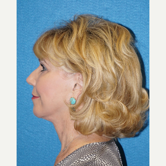 68 year old woman treated with Facelift after 3576642