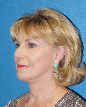 68 year old woman treated with Facelift 3576642