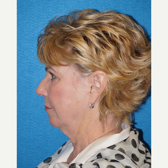 68 year old woman treated with Facelift before 3576642