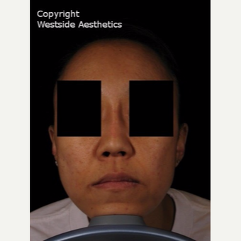 Bumpy Nose Correction after 2977207