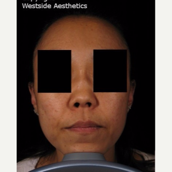 Bumpy Nose Correction before 2977207