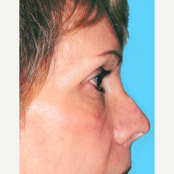 Rhinoplasty before 3814307