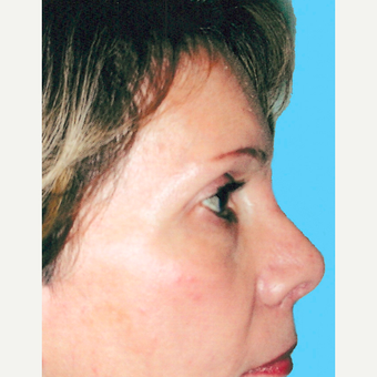 Rhinoplasty after 3814307