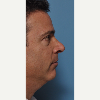 1 Year Post Male Rhinoplasty, Chin Implant, Neck Liposuction before 3254883