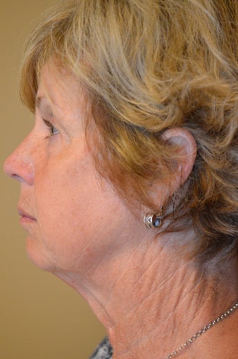 55-64 year old woman treated with Facelift, Browlift, Upper and Lower Blepharoplasty 3371210