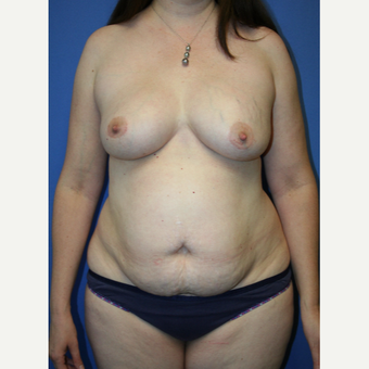 45-54 year old woman treated with Mommy Makeover before 2993998