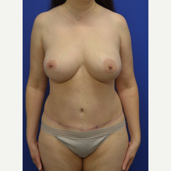 45-54 year old woman treated with Mommy Makeover after 2993998