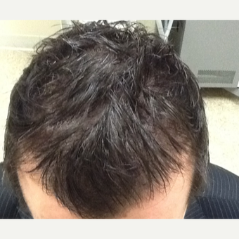 35-44 year old man treated with Hair Loss Treatment after 3506327