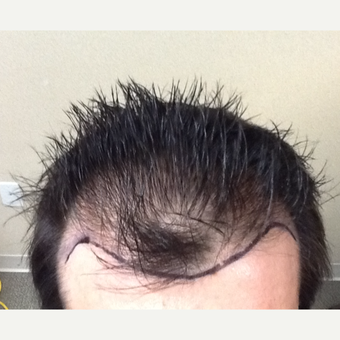 35-44 year old man treated with Hair Loss Treatment before 3506327