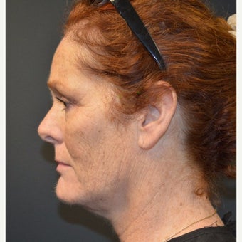 Female Patient One Month After One Kybella Treatment after 2030406