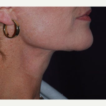 45-54 year old woman treated with Neck Lift after 1673984