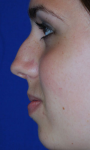 Rhinoplasty before 605531