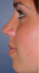 Rhinoplasty after 605531