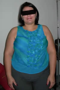 34 year old woman treated for severe obesity before 1102251