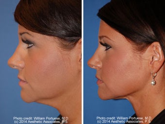 Neck Liposuction before 1389717