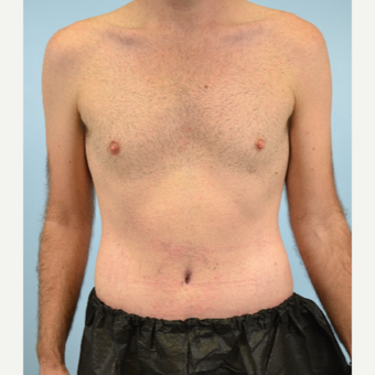 32 year old man treated with Tummy Tuck after 3432253