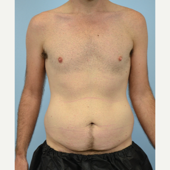 32 year old man treated with Tummy Tuck before 3432253