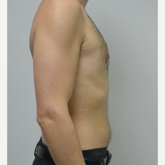 25-34 year old man treated with Male Breast Reduction after 3683768