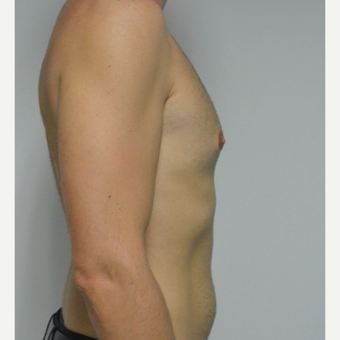 25-34 year old man treated with Male Breast Reduction before 3683768