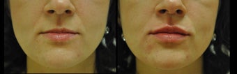 Juvederm for Lip Augmentation before 981988