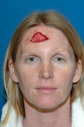 Forhead reconstruction after Mohs surgery before 665299