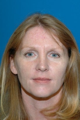 Forhead reconstruction after Mohs surgery after 665299