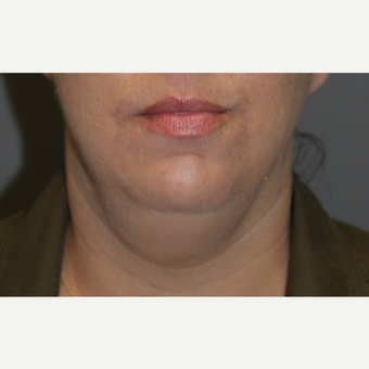 35-44 year old woman treated with Kybella before 3147388
